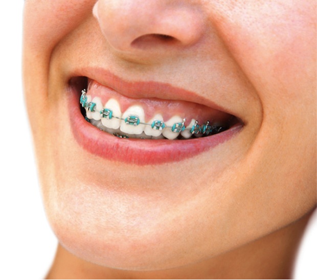 Conventional Braces - NoFrills Dental