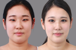korean plastic surgery