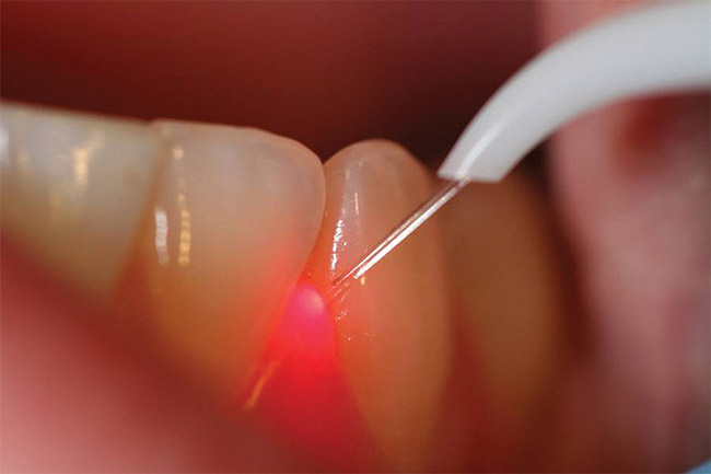 dental-laser-tamiami