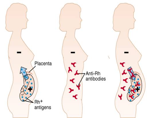 Egypt's Pharmacists Syndicate Warns RH Negative Pregnant ...