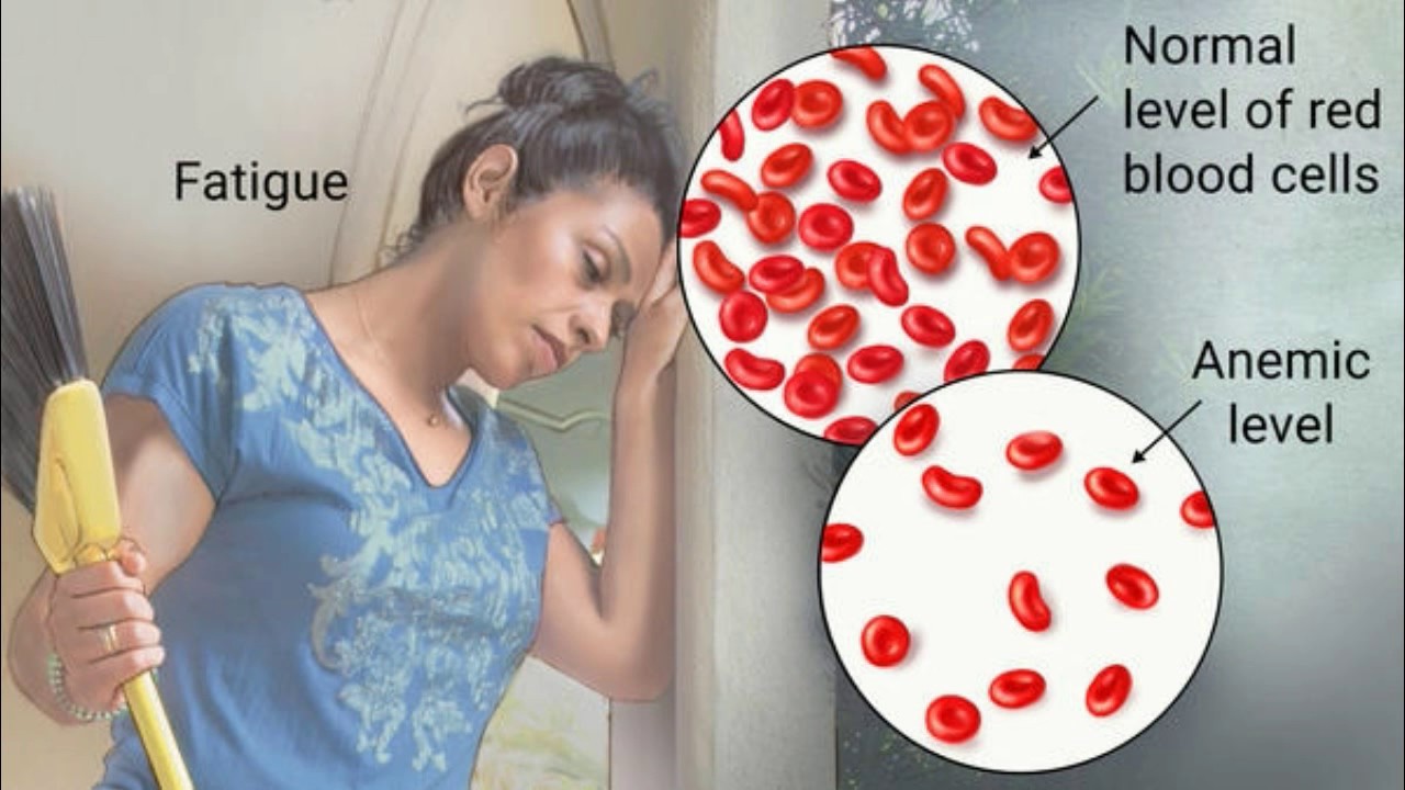 https://nutrition.org/new-focus-reducing-anemia-adolescent-girls/