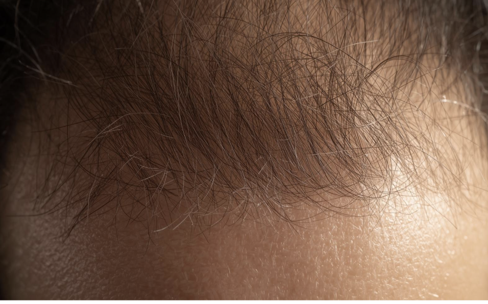 Telogen Effluvium Explained: Causes and Recovery - Scoop Empire